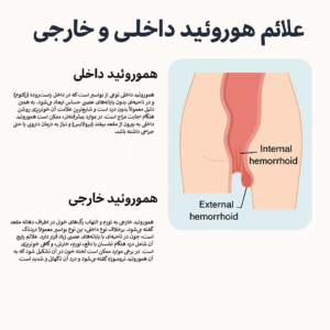 تصویر آموزشی علائم هموروئید داخلی و خارجی به زبان فارسی با نمودار شماتیک