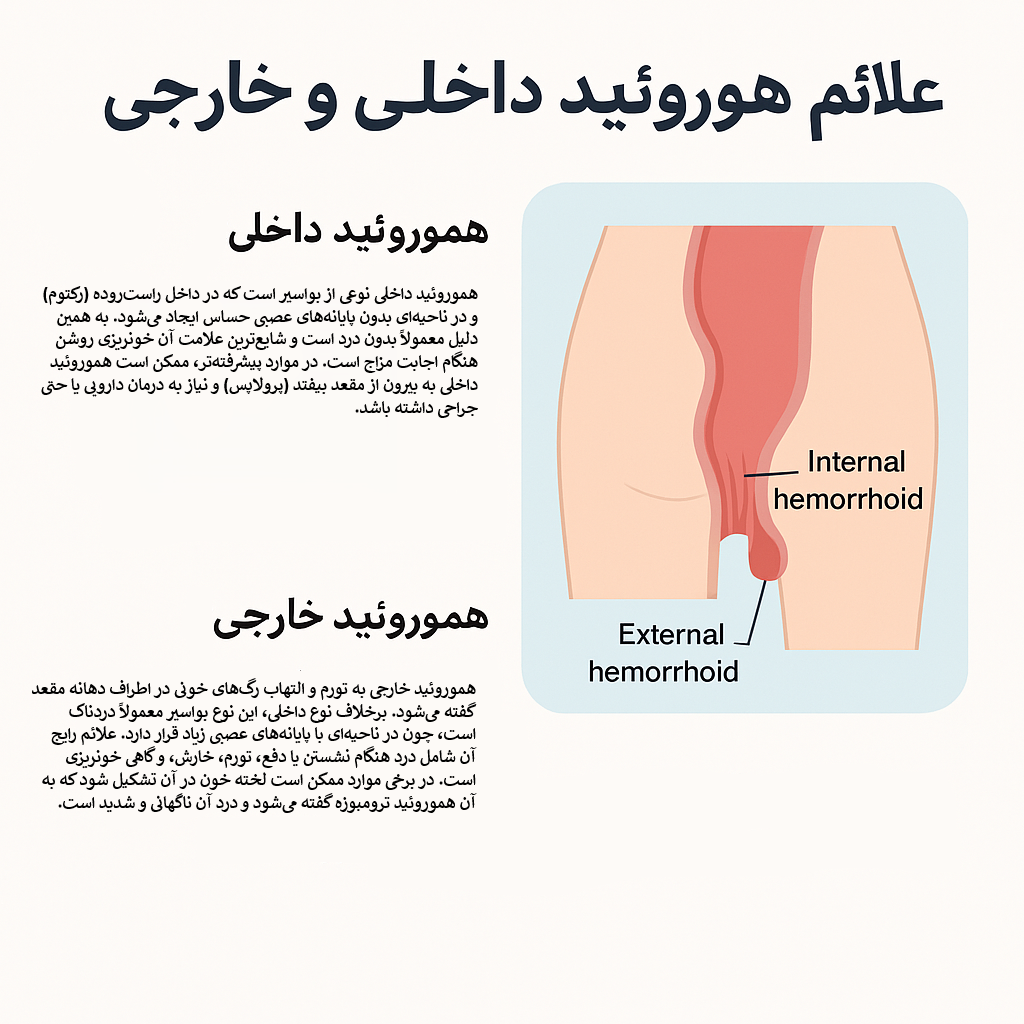 تصویر آموزشی علائم هموروئید داخلی و خارجی به زبان فارسی با نمودار شماتیک