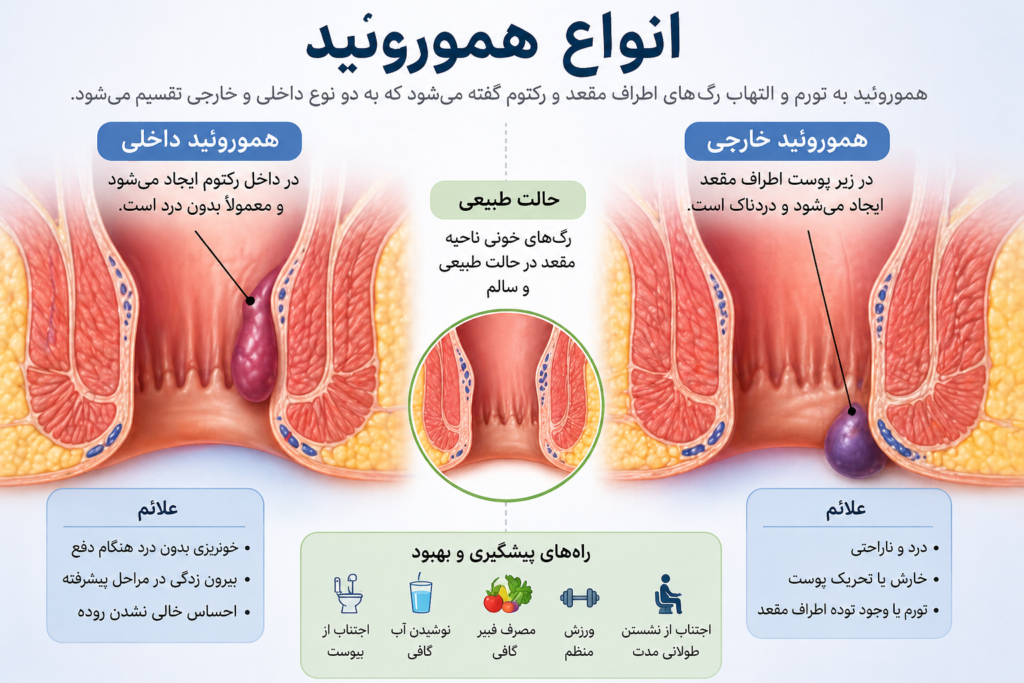 تشخیص انواع هموروئید