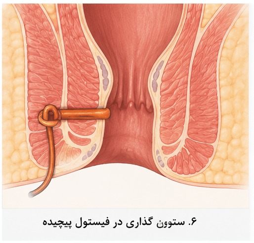 ستون گذاری برای عمل