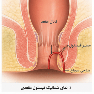 فیستول مقعدی